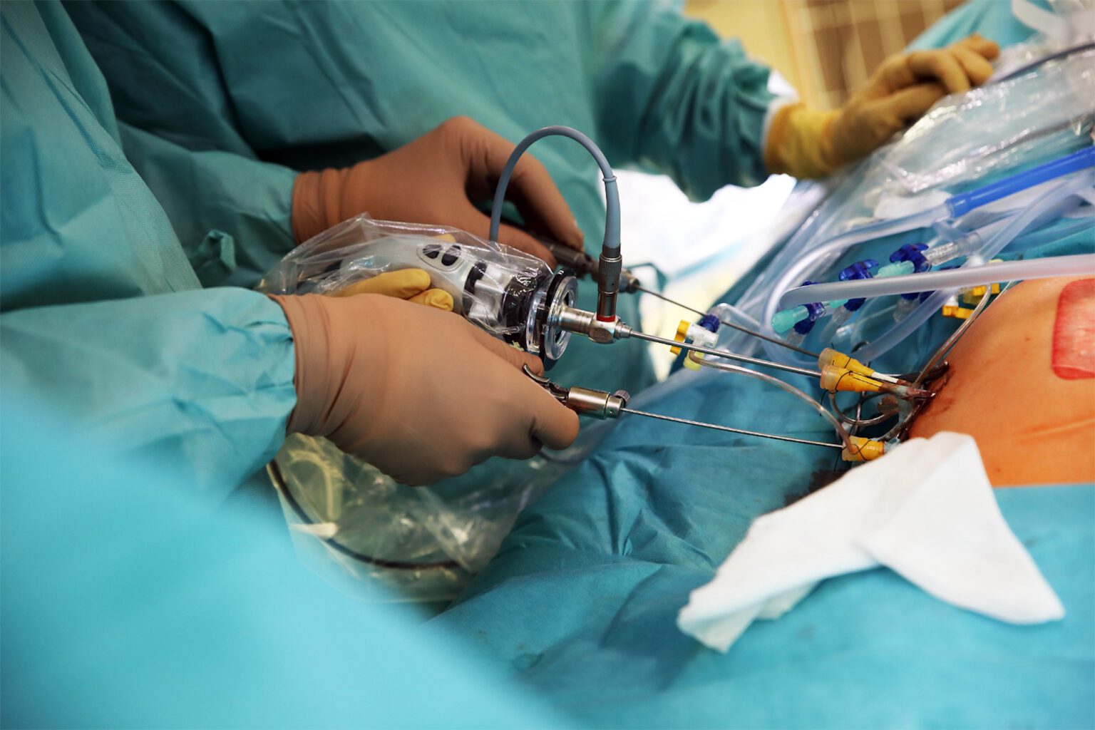 Spina bifida, Chiari-Typ-II-Malformation & Hydrocephalus – DZFT